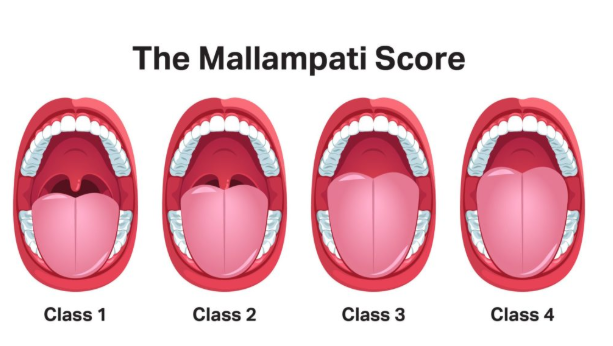 Mallampati score
